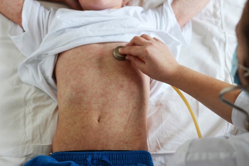 世衛發布麻疹警報 歐洲染疫人數暴增45倍