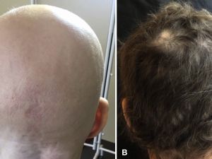 治療斑禿脫髮 美FDA批准首支口服藥